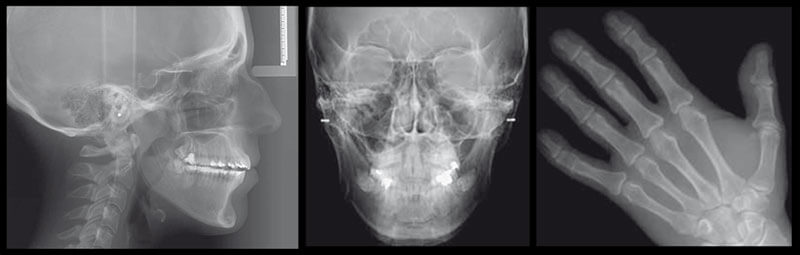 歯科用CT OC300PLUS（3D）セファロ付き（左）