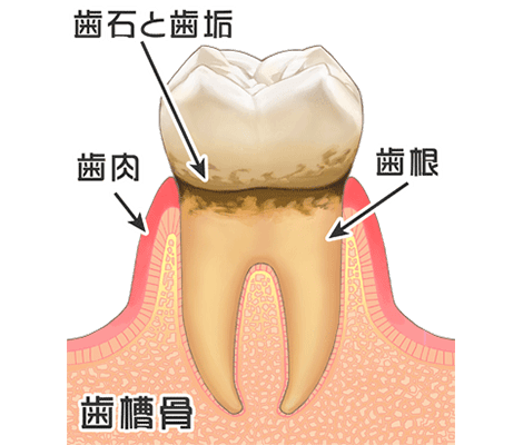 歯周病治療：SRP